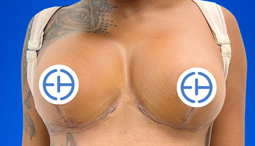 After: Mastopexy