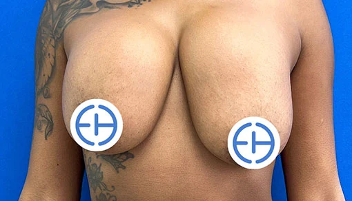 Before: Mastopexy