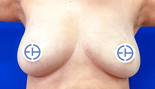 Before: Mastopexy