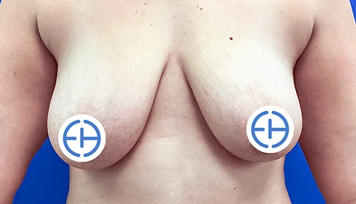 Before: Mastopexy