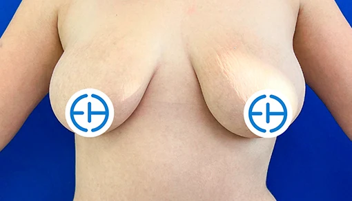 Before: Mastopexy