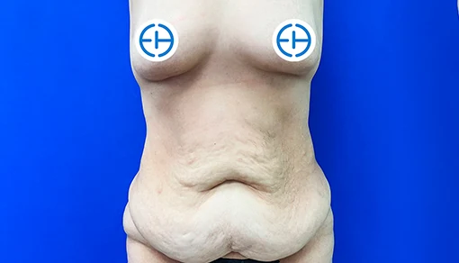 Before: Mommy Makeover