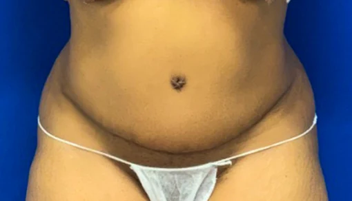 After: Tummy Tuck