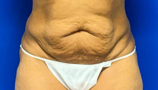 Before: Tummy Tuck