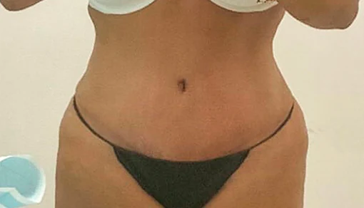 After: Tummy Tuck