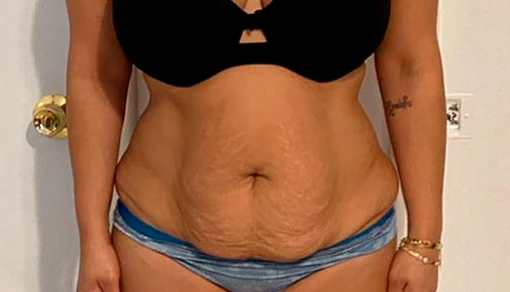 Before: Tummy Tuck