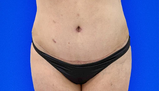 After: Tummy Tuck
