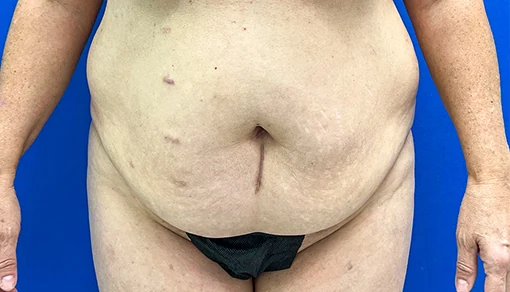 Before: Tummy Tuck