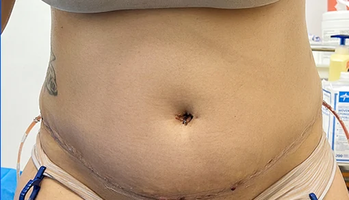 After: Tummy Tuck