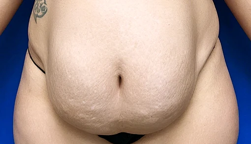 Before: Tummy Tuck