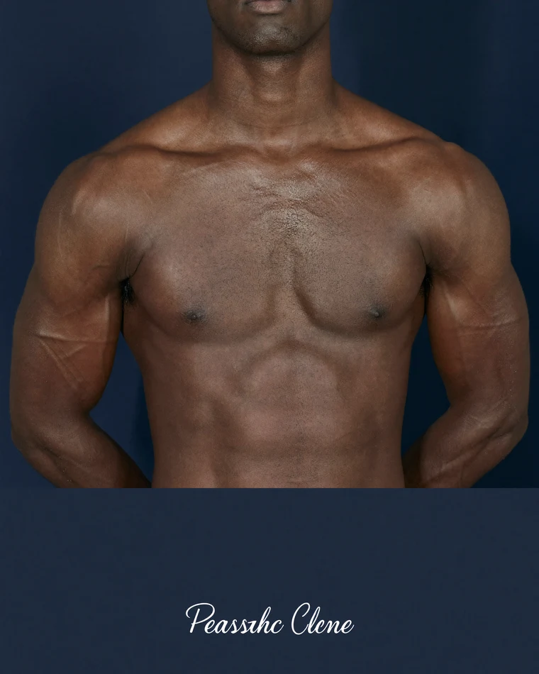 Gynecomastia